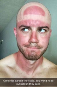 People Who Realized The Importance Of Sunscreen The Hard Way